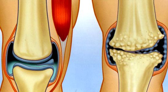 Лечение артроза коленного сустава (гонартроза, артрита), многопрофильная клиника  МедПросвет