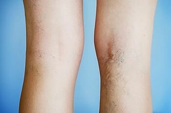 Склерозирование вен на ногах – альтернатива традиционной операции, многопрофильная клиника  МедПросвет