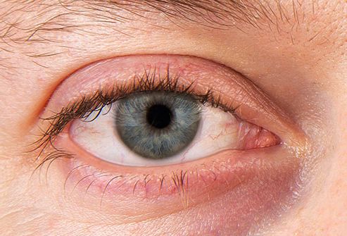 Синдром сухого глаза, многопрофильная клиника  МедПросвет