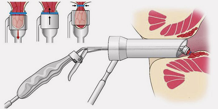 Лигирование латексными кольцами, многопрофильная клиника  МедПросвет