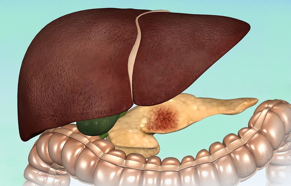 Онкомаркеры на рак поджелудочной железы, многопрофильная клиника  МедПросвет