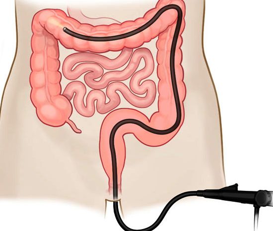 Колоноскопия кишечника под наркозом, многопрофильная клиника  МедПросвет