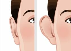 Отопластика - коррекция формы ушей, многопрофильная клиника  МедПросвет