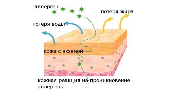 Экзема кожи: причины, симптомы, диагностика и лечение, многопрофильная клиника  МедПросвет