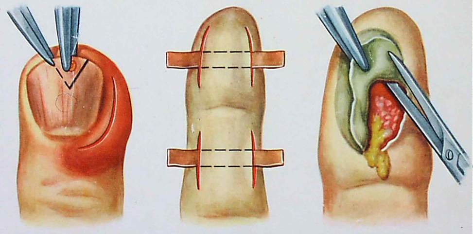 Лечение панариция пальца руки - гнойного нарыва возле ногтя, вскрытие  панариция | Медицинский центр - МедПросвет
