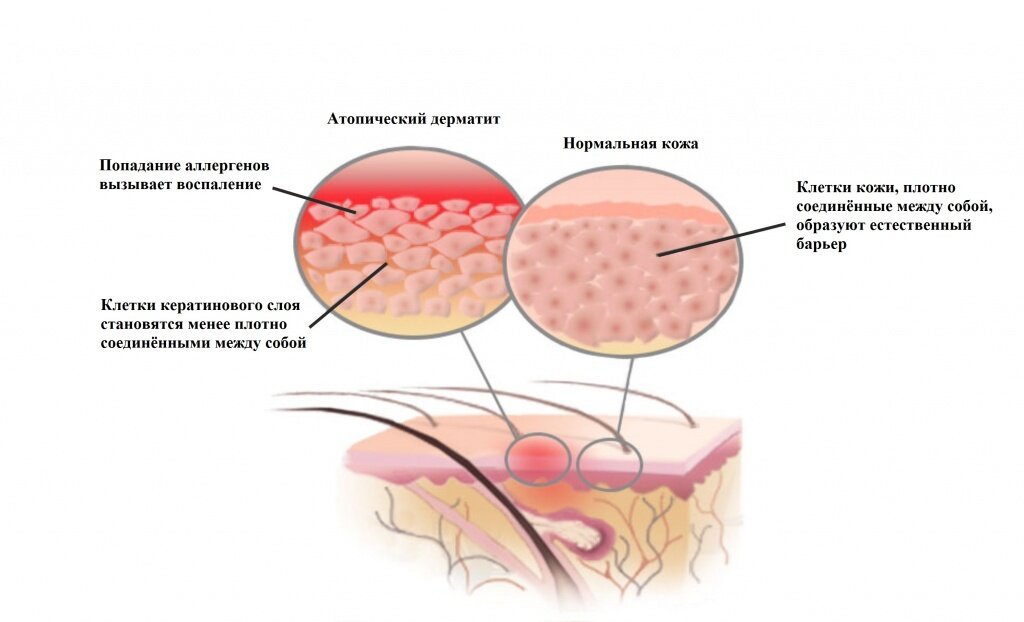 Атопический дерматит: причины, диагностика, лечение, многопрофильная клиника  МедПросвет