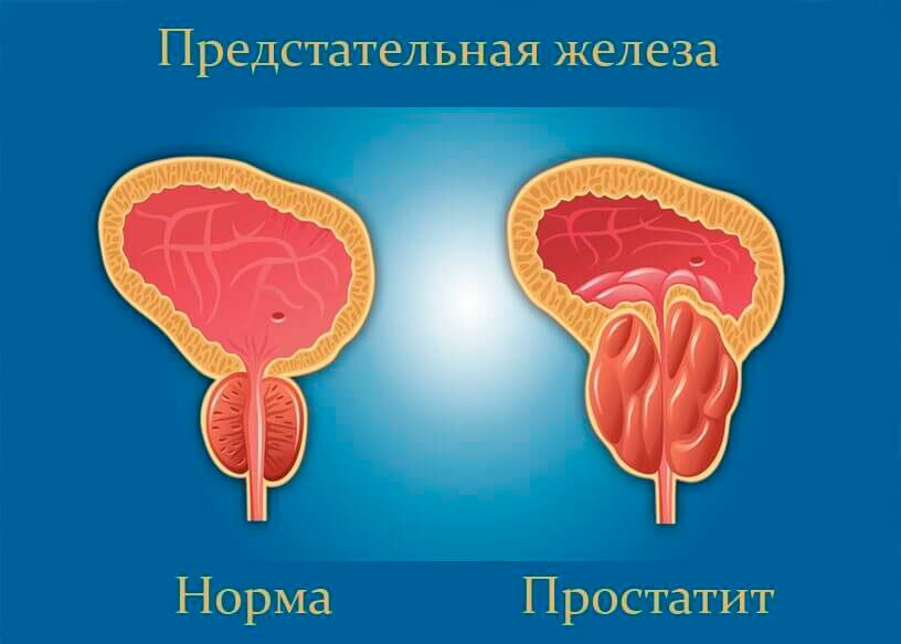 схема про простатит