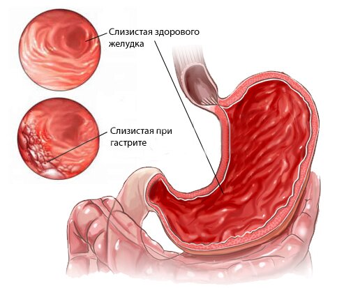 гастрит схематично