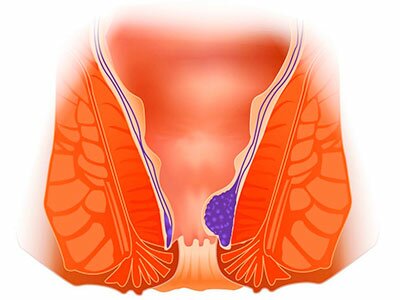 геморрой схематично картинка