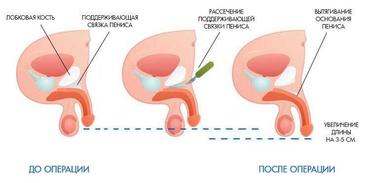 Лигаментотомия схематично