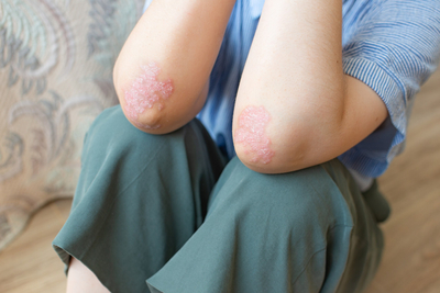 Шелушится и трескается кожа на локтях - симптомы и лечение в СПб |  Медицинский центр - МедПросвет