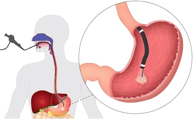 биопсия при эндоскопии схема