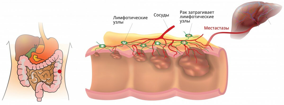 рак кишечника стадии картинка