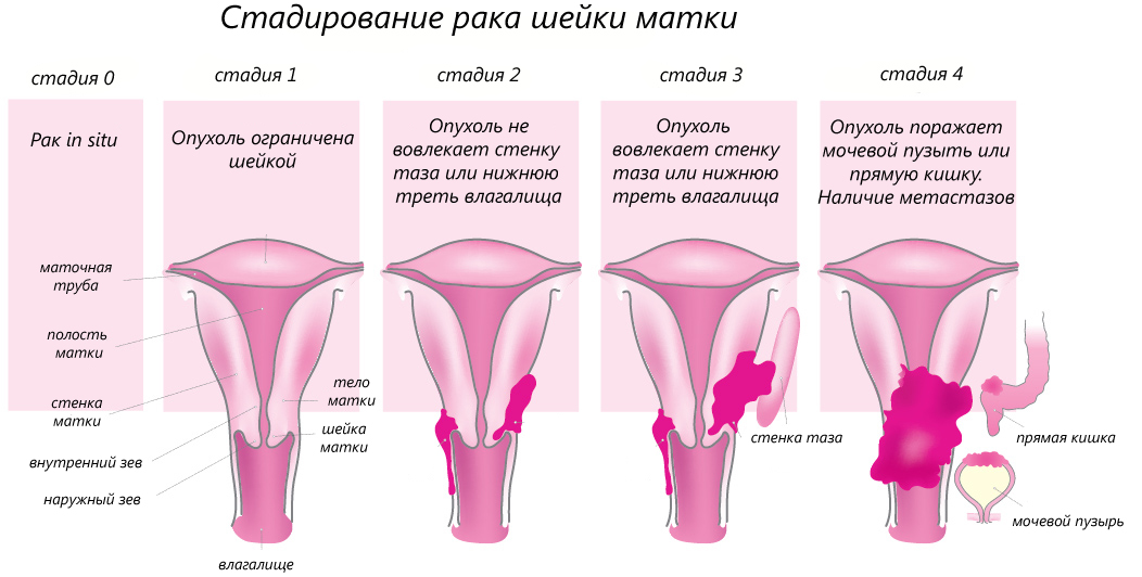 рак шейки матки стадии картинка
