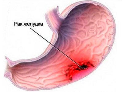 рак желудка картинка