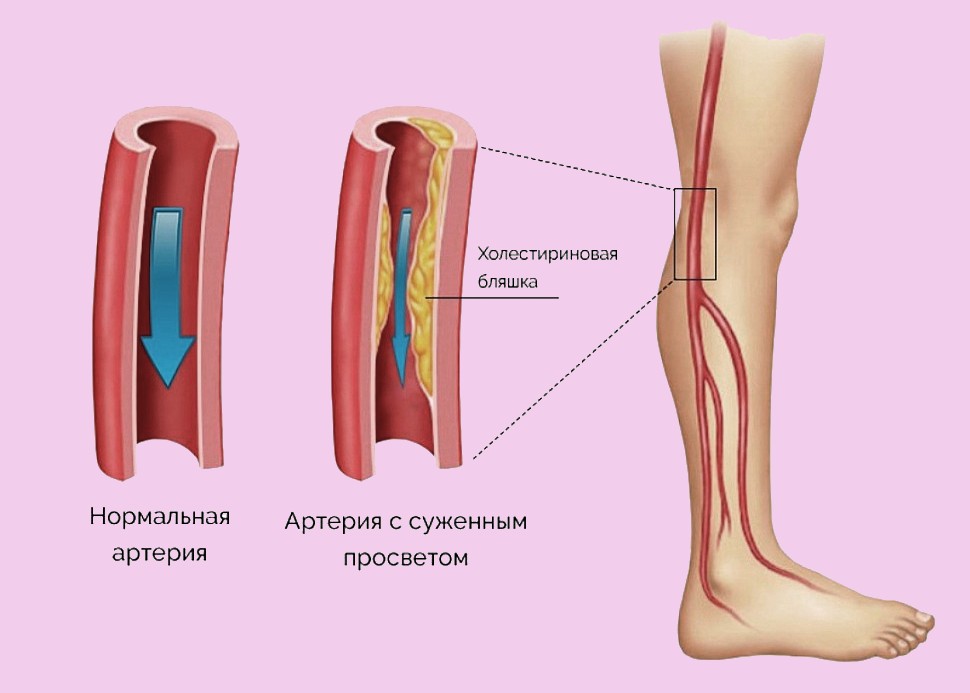 схематично атеросклероз ног