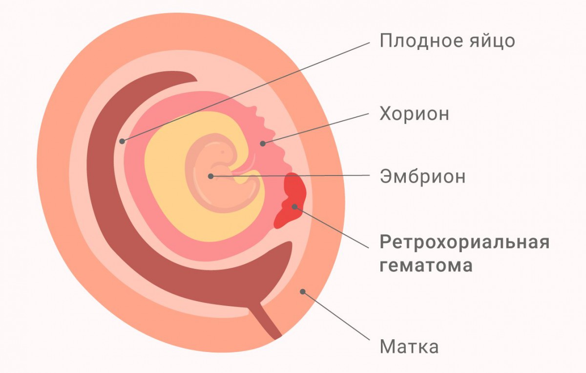 УЗИ рехтохориальной гематомы при беременности - цена в СПб | Клиника МедПросвет
