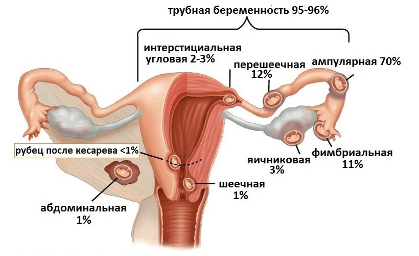 Виды патологической беременности схема