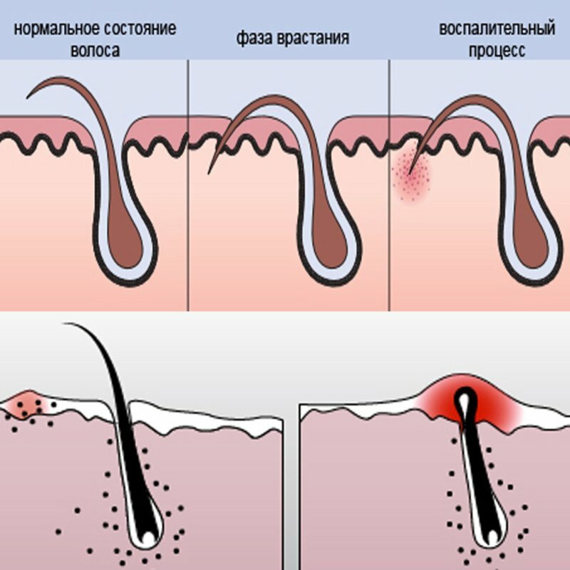 вросший волос схематично