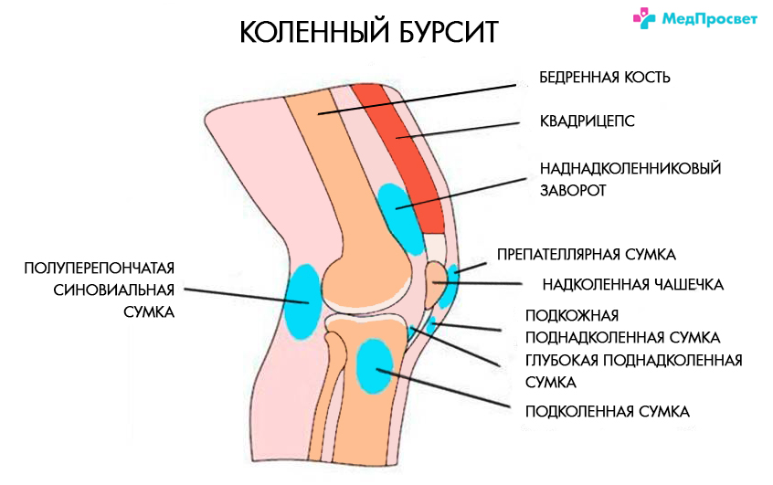 Боль в колене при коленном бурсите