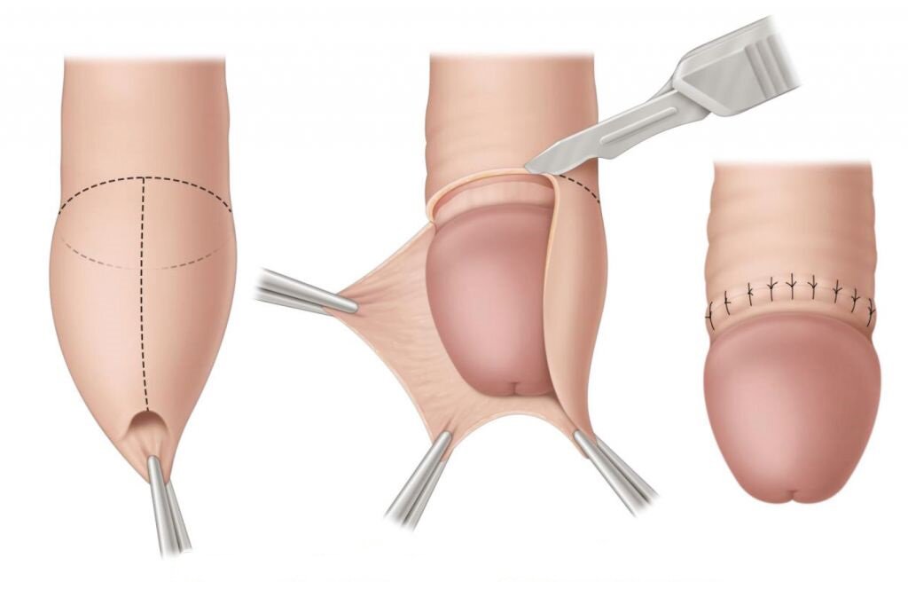 Обрезание крайней плоти: циркумцизия у взрослых, многопрофильная клиника  МедПросвет