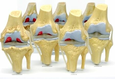 Протезы синовиальной жидкости для лечения артроза коленного сустава, многопрофильная клиника  МедПросвет