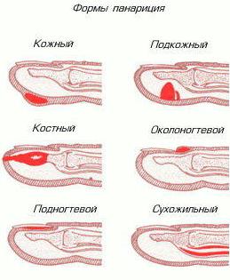 Панариций (гнойный нарыв на пальце): причины, диагностика, лечение, многопрофильная клиника  МедПросвет