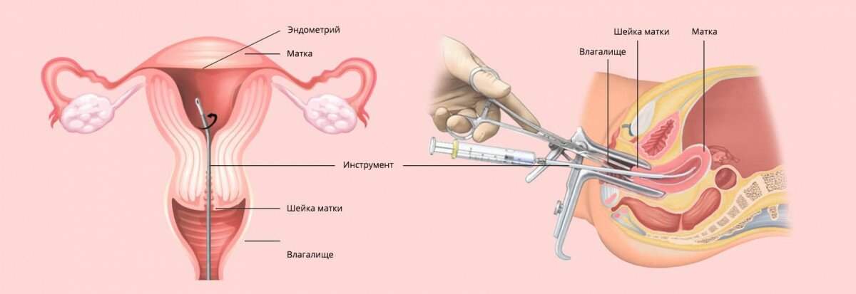 Пайпель биопсия эндометрия, многопрофильная клиника  МедПросвет