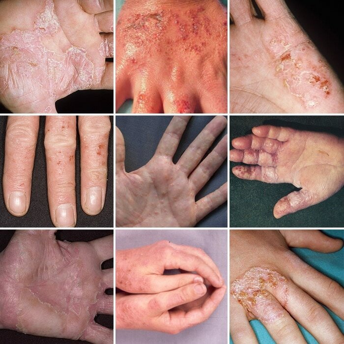 Экзема кожи: причины, симптомы, диагностика и лечение, многопрофильная клиника  МедПросвет