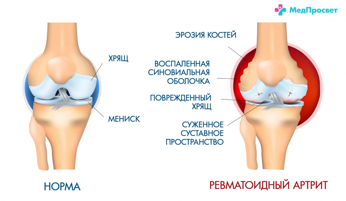 Боль в колене из-за ревматоидного артрита