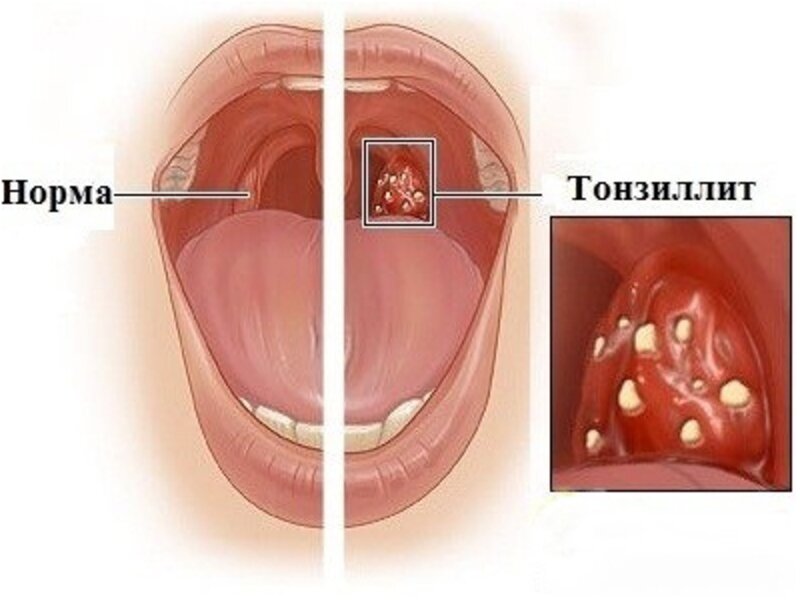 Хронический тонзиллит - симптомы, диагностика, лечение, профилактика, многопрофильная клиника  МедПросвет