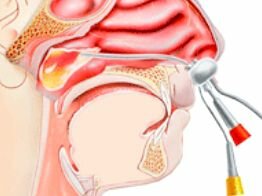Лечение гайморита и других синуситов без прокола, многопрофильная клиника МедПросвет