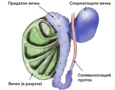 Удаление кисты яичка, придатка яичка (сперматоцеле), многопрофильная клиника  МедПросвет