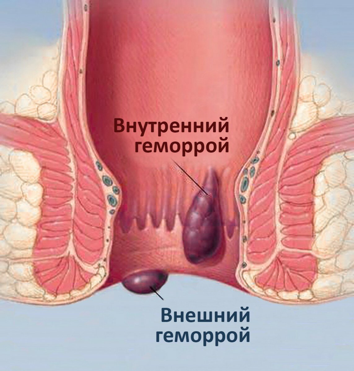 Лигирование латексными кольцами, многопрофильная клиника  МедПросвет